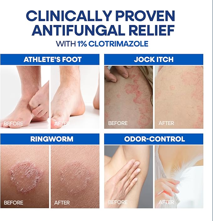 Hermon Clotrimazole Antifungal Treatment Cream &amp Soap Kit: Antifungal Cream for Athletes Foot Jock Itch Ringworm with Anti Fungal Soap - Relieves Itching Burning Cracking - 57g Tube / 113g Bar